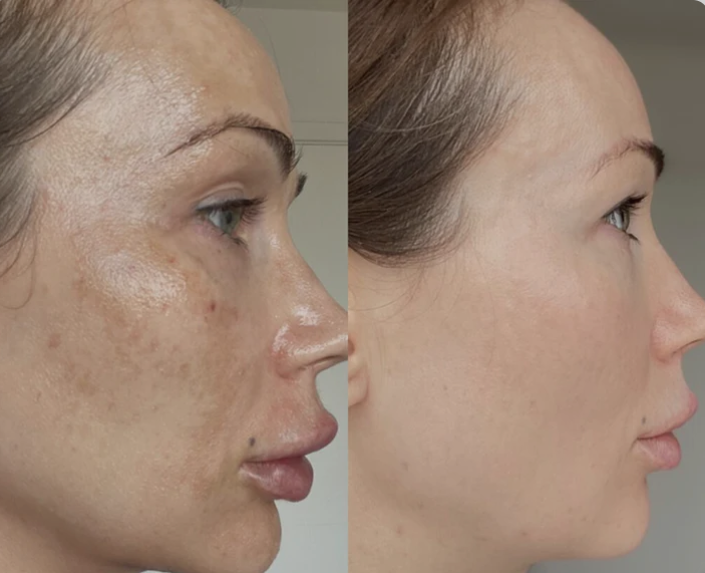 Essência Anti-hiperpigmentação Avançada Ceoerty® MelantraX