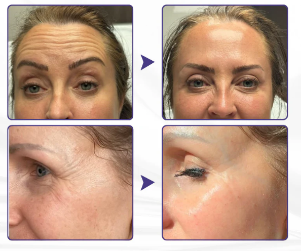 Creme Firmador de Pele Avançado ElastaPro Emu Oil