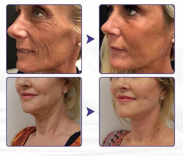 Creme Firmador de Pele Avançado ElastaPro Emu Oil